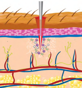 Microneedling Procedure Image