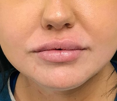 Before and After Picture