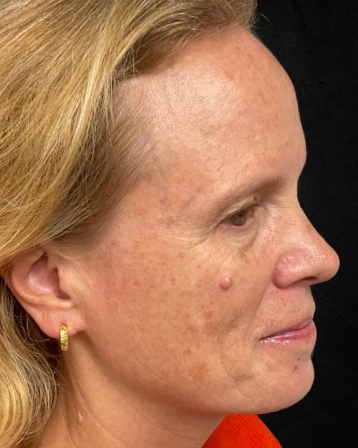 Before and After Picture