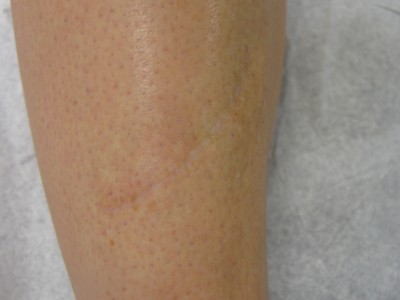 Before and After Picture