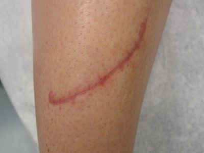 Before and After Picture