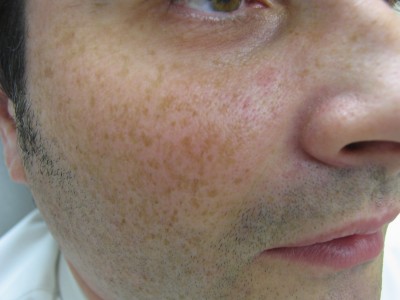 Before and After Picture