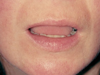 Before and After Picture