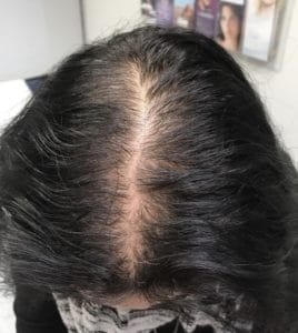 PRP Injections for Hair Loss