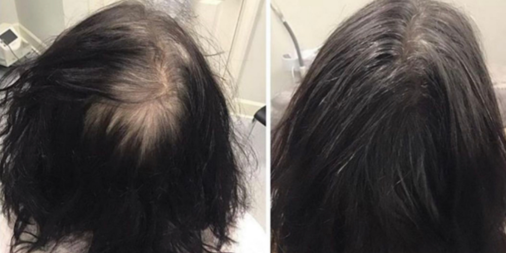PRP Injections for Hair Loss