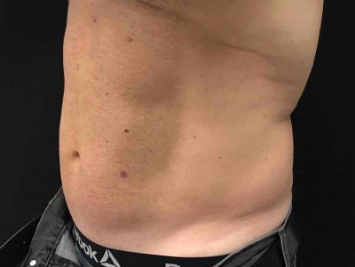 Before and After Picture