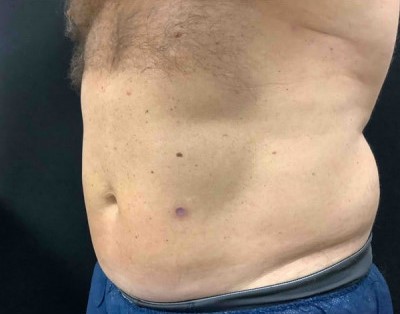 Before and After Picture