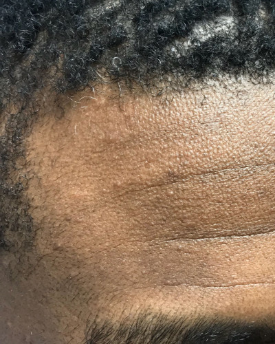 Before and After Picture